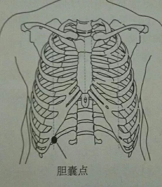 而引发急性胆囊炎时,可在肋缘下触及肿大的胆囊,并有压痛,称为murphy'